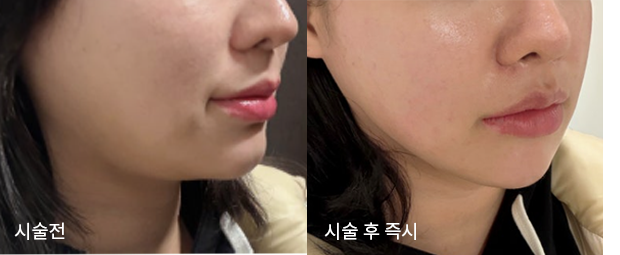 올타이트 리프팅 전후 사진