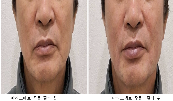 마리오네트 주름 필러 전후