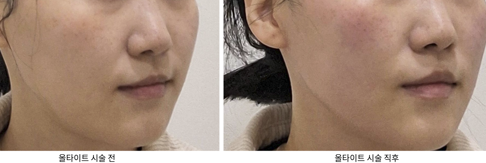 올타이트 시술 전 후 사진