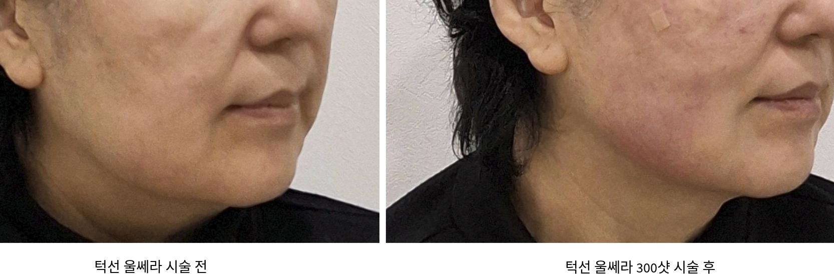 턱선 울쎄라 시술 전후