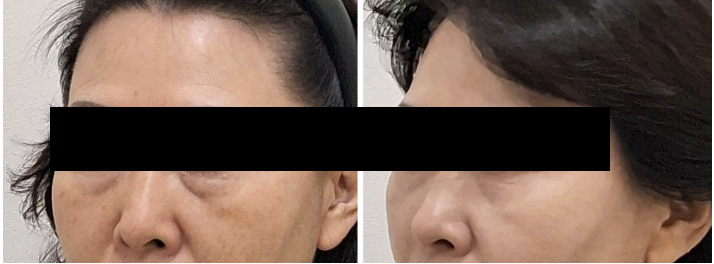 눈밑 쳐짐  볼뉴머 300샷
