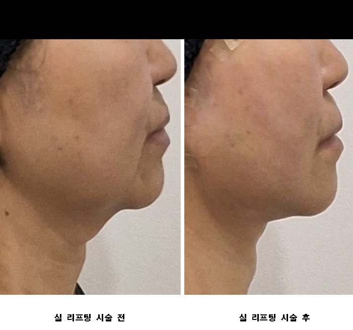 원더트리플 프리미엄 실리프팅 (마리오네트, 턱밑살 개선 목적)
