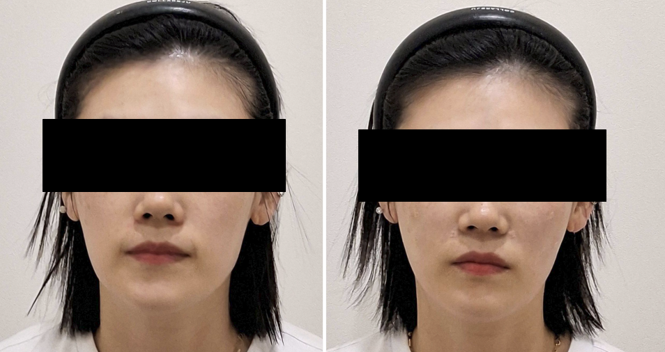 옆볼+팔자 필러로 얼굴 컨투어 교정