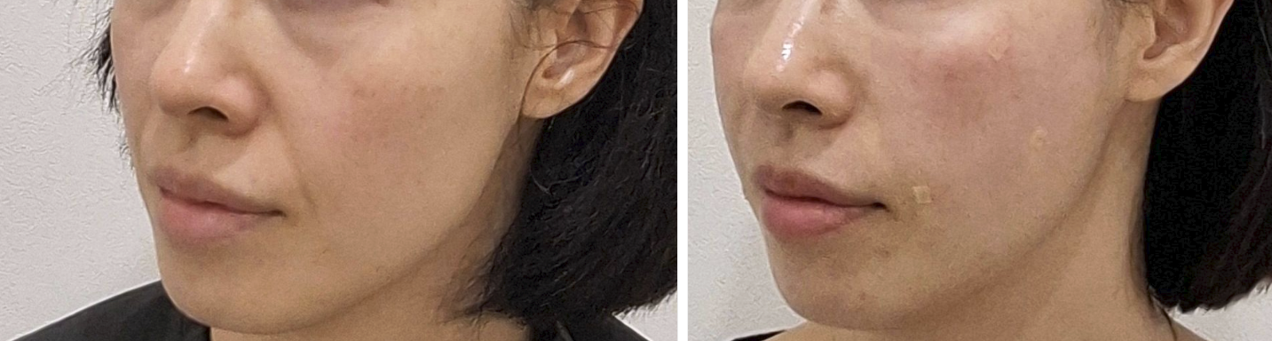 쥬베룩 볼륨 2회차 후