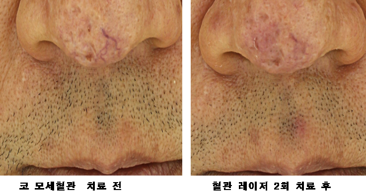 모세혈관 확장증 치료